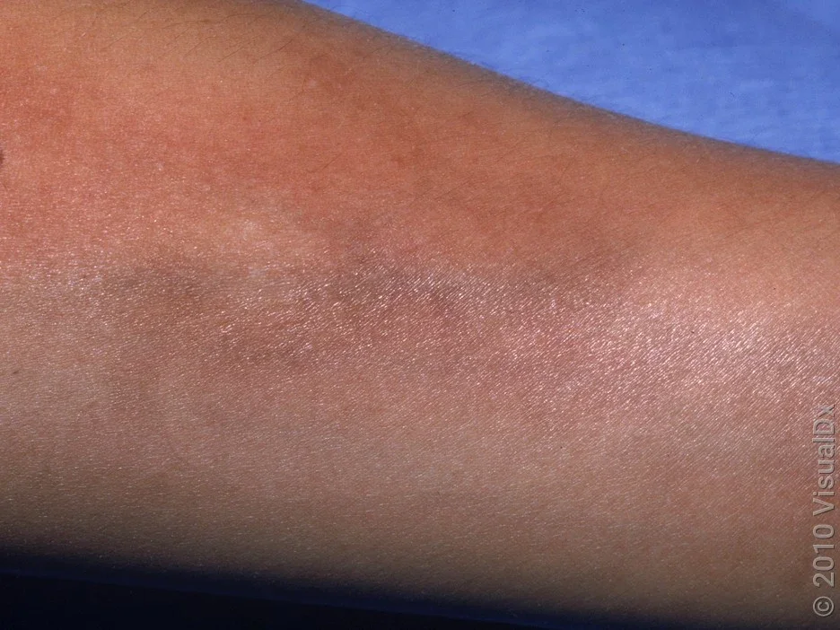 Morphea on the arm. 