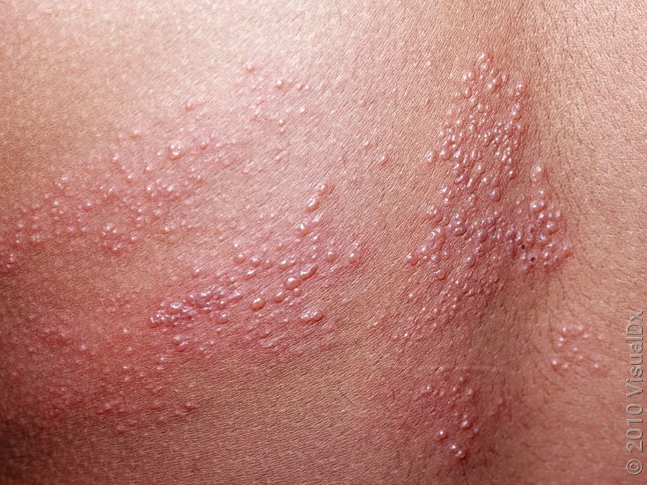 Fluid-filled skin blisters along a dermatome.