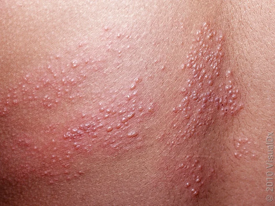 Fluid-filled skin blisters along a dermatome. 