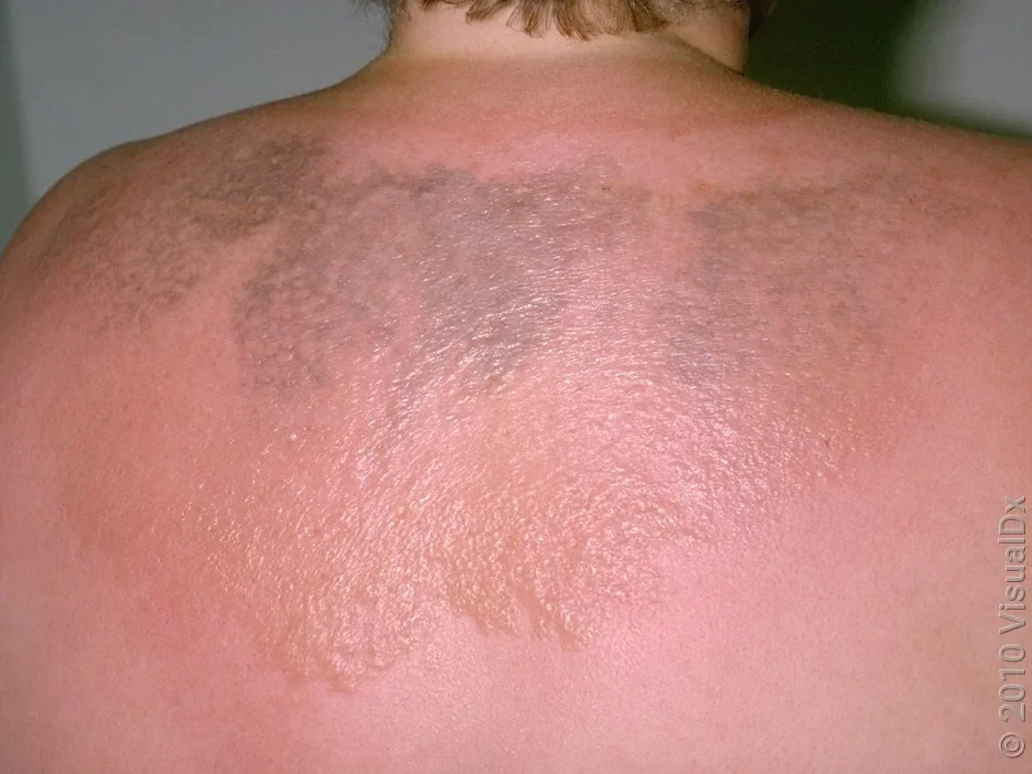 Close-up of multiple sunburn blisters on the back.