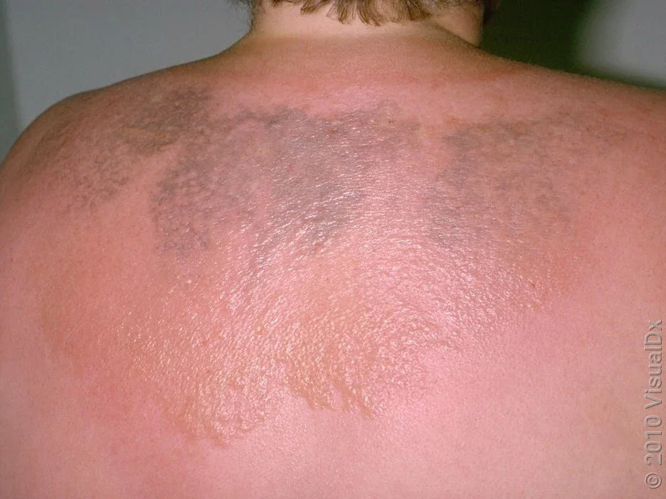 Close-up of multiple sunburn blisters on the back.