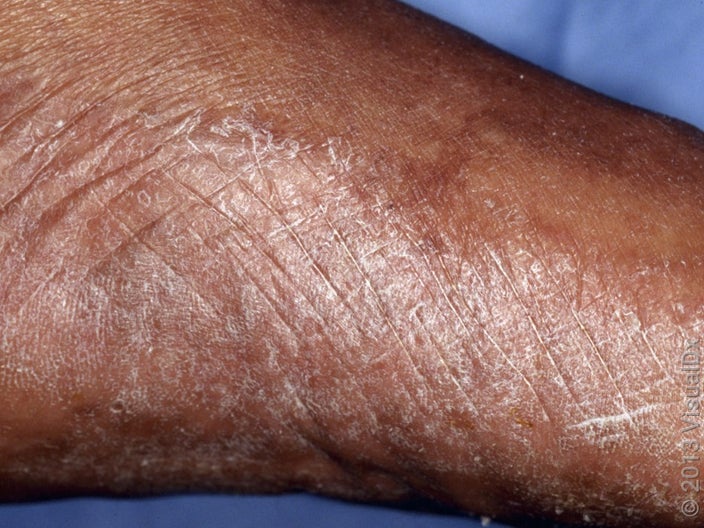 Minor athlete’s foot causes a scaly rash on the sides and bottom of the foot. 
