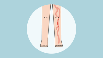 Deep vein thrombosis: quiz DVT-01