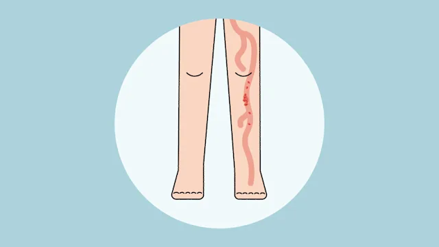 Deep vein thrombosis: quiz DVT-01