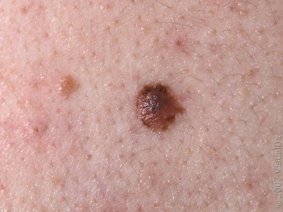 Close-up of what a mildly atypical mole can look like. 