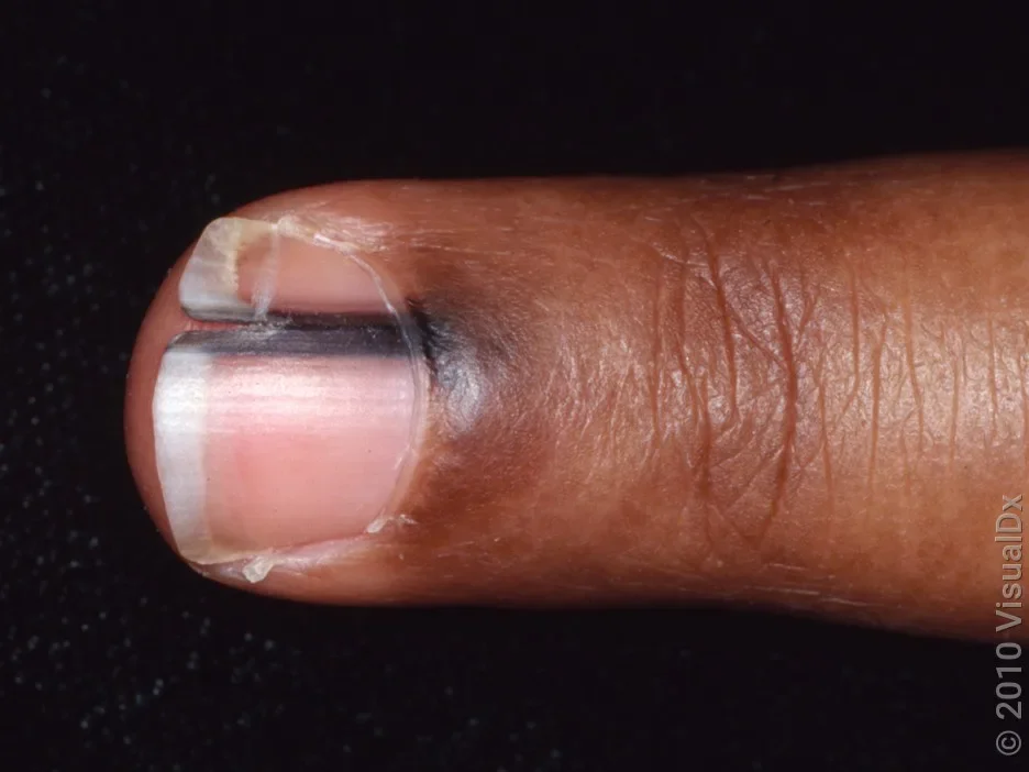 Close-up of a black streak on the fingernail in Black skin caused by melanoma.