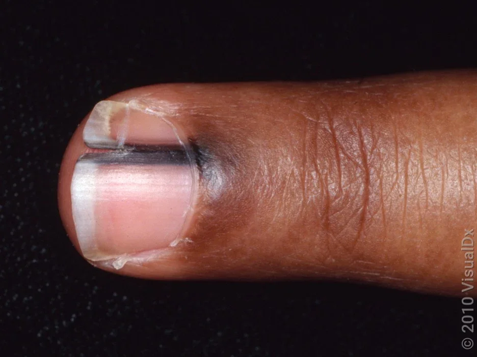 Close-up of a black streak on the fingernail in Black skin caused by melanoma. 