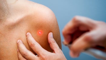 Health: Skin cancer: closeup skin cancer removal-525002641