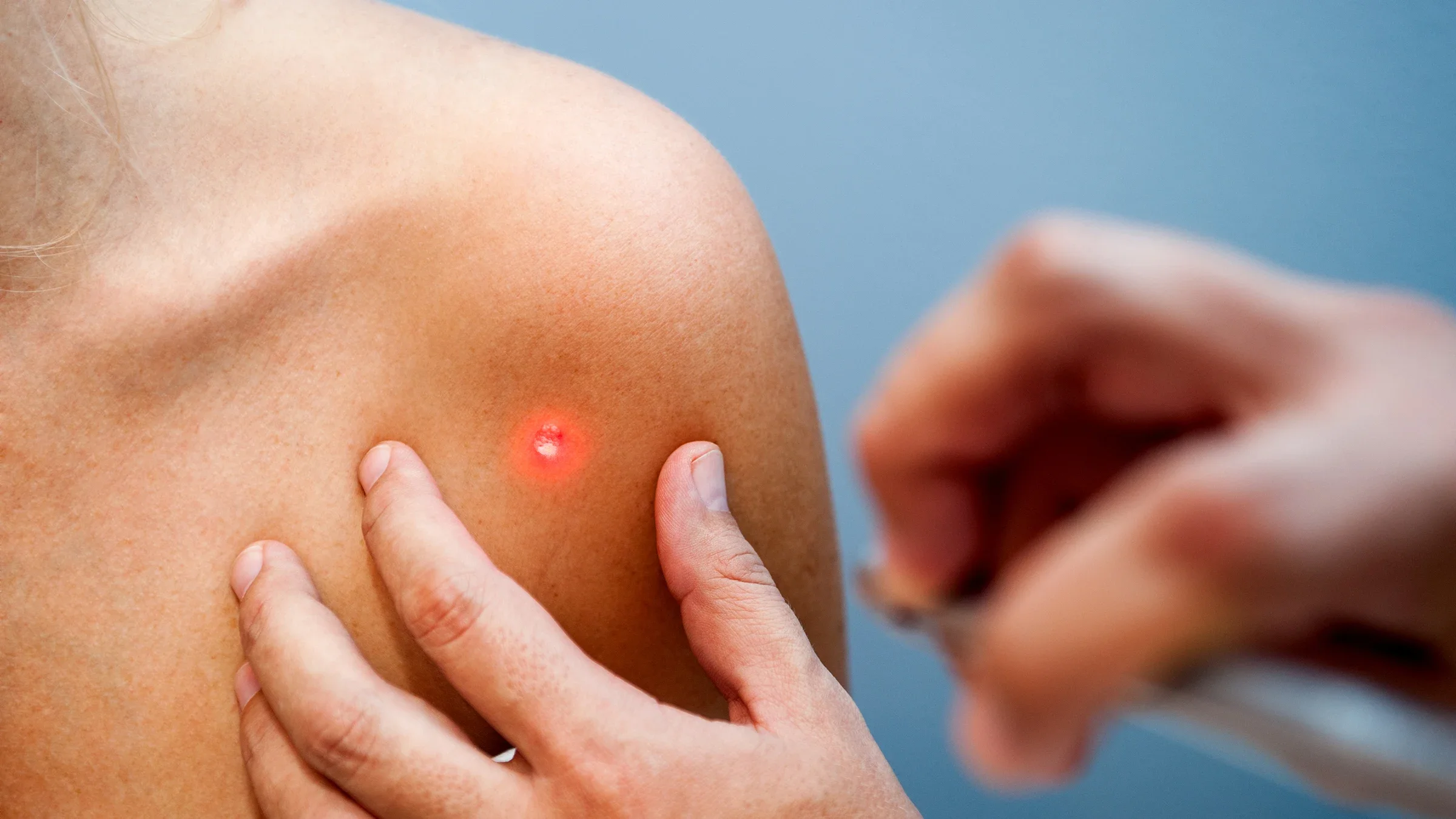 Health: Skin cancer: closeup skin cancer removal-525002641