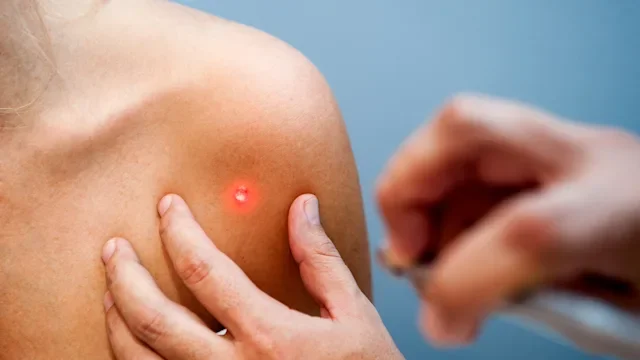 Health: Skin cancer: closeup skin cancer removal-525002641