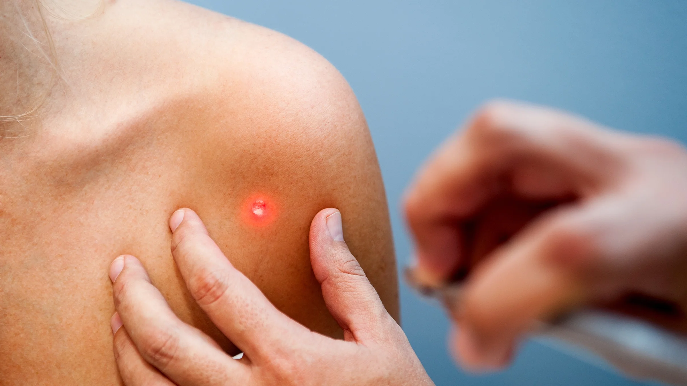 Close-up on a doctor using a laser to remove a spot of skin cancer on a patient's shoulder.