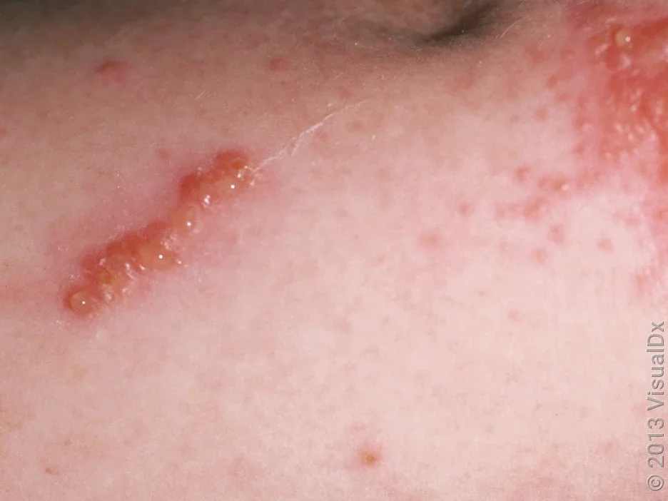 Close-up blisters from allergic contact dermatitis caused by poison ivy, oak, and sumac.