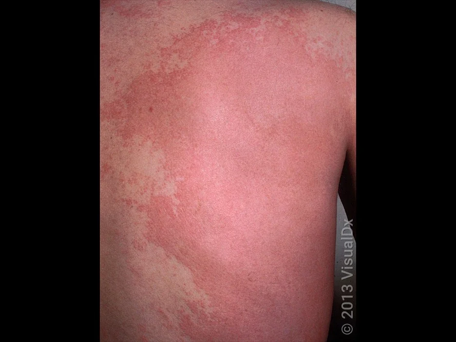 A person’s back covered by a large hive.