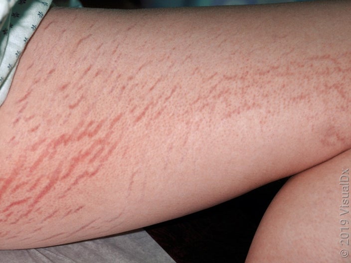 Close-up of new stretch marks on the thigh. 