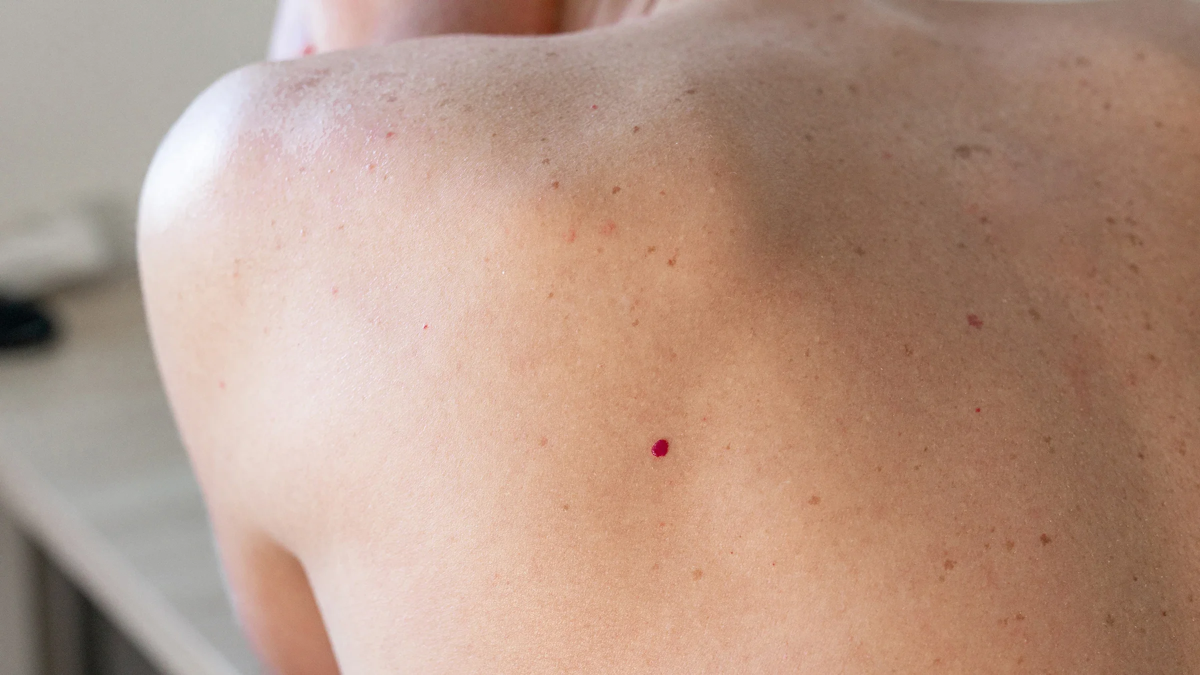 Close-up photo of a cherry angioma on a person’s back
Andrey Maximenko/iStock via Getty Images Plus