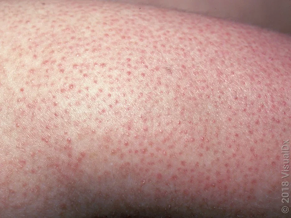 Keratosis on the arm in fairer skin.