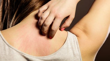 Antihistamine: closeup woman scratching rash on back 614147734