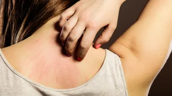 Antihistamine: closeup woman scratching rash on back 614147734