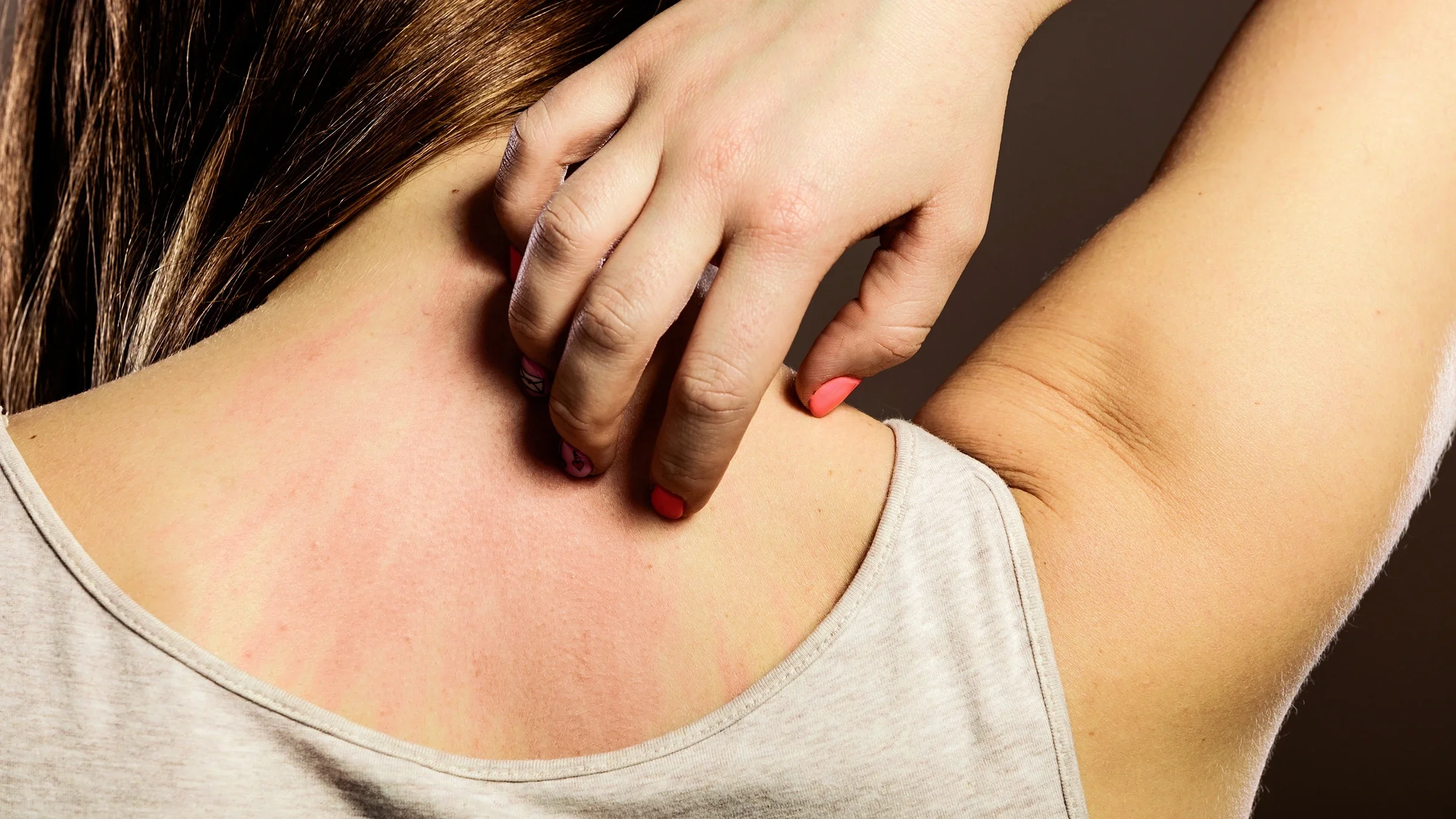 A woman is scratching her back, which appears to have an allergy-related rash on it, in a close-up.