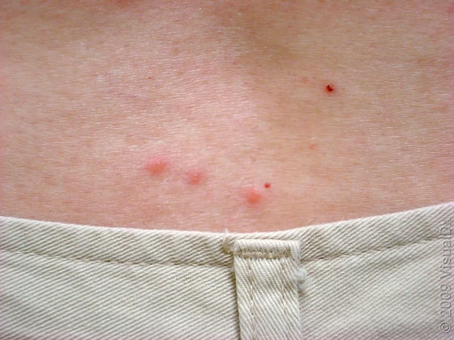 Close-up of a line of bedbug bites on the lower back.