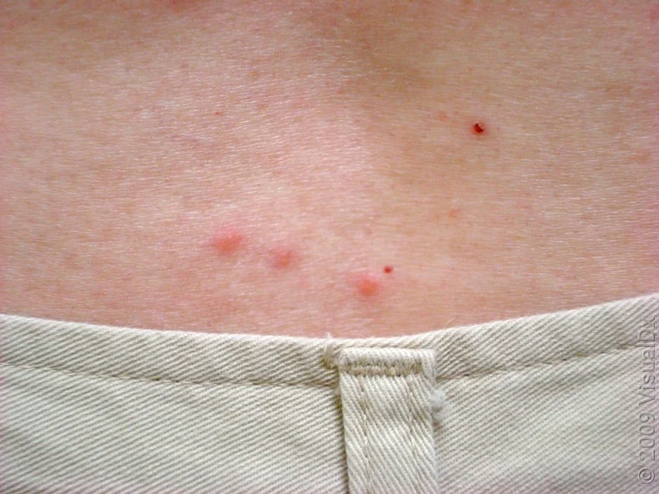 Close-up of a line of bedbug bites on the lower back.