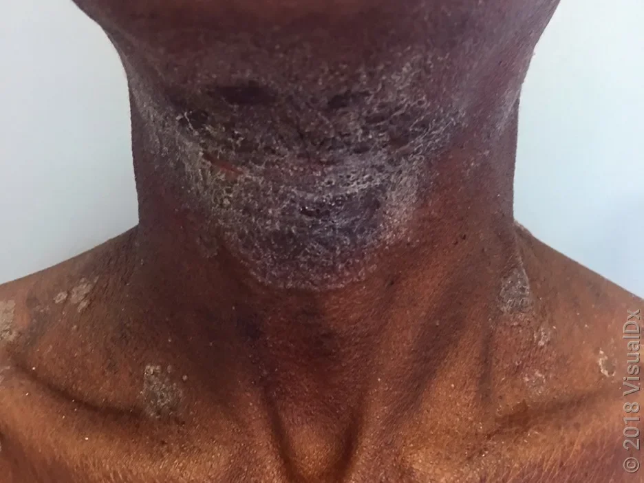 Front of the neck with psoriasis.