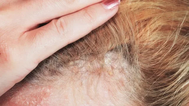 What Is Scalp Psoriasis? Symptoms, Pictures, Causes, and Treatments