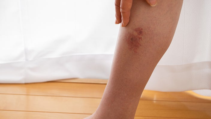 erythema nodosum