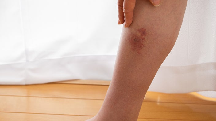 Close-up of a person's leg with a rash that looks like bacterial cellulitis.
