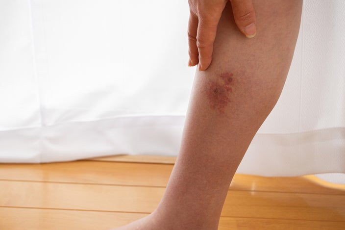 5 Reasons That You Need To Go To The Er For Cellulitis Goodrx