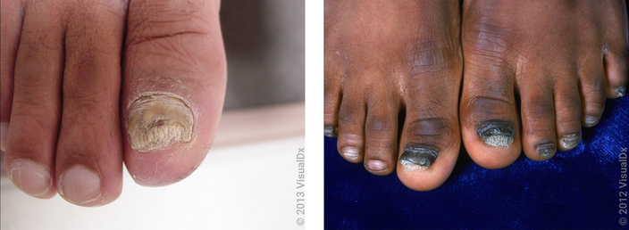 Toenail fungus treatment hot sale otc