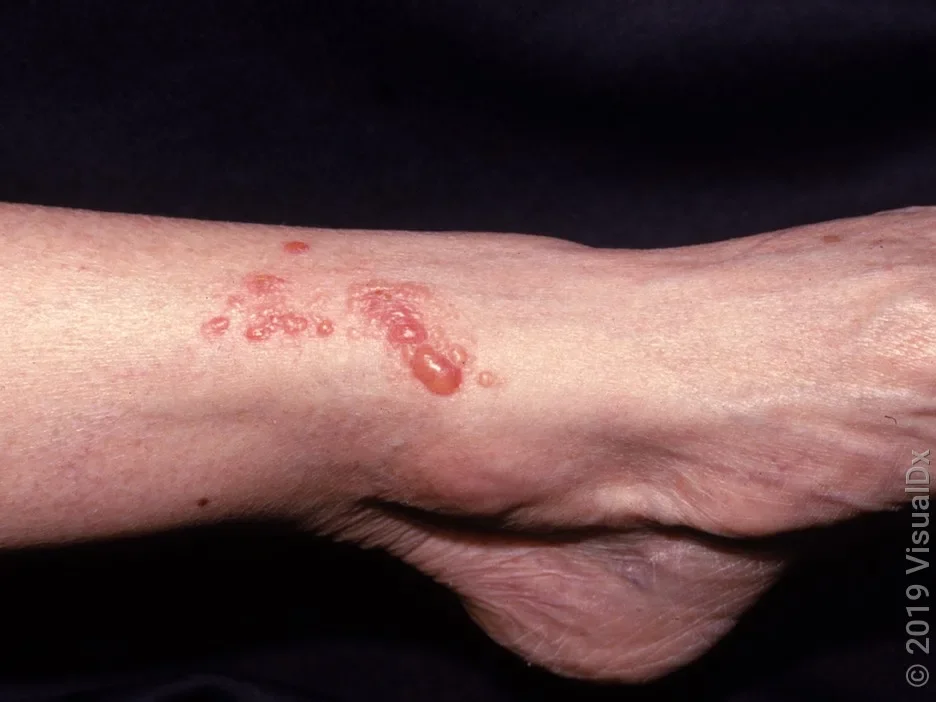 A close-up look at a leg with blisters from poison ivy.