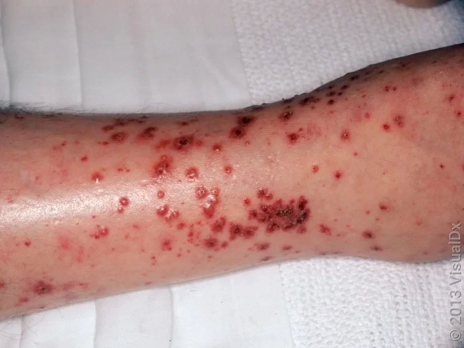 A vasculitis rash on the leg. 