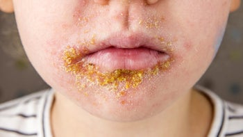 Health: Skin infection: closeup mouth impetigo 1204003540