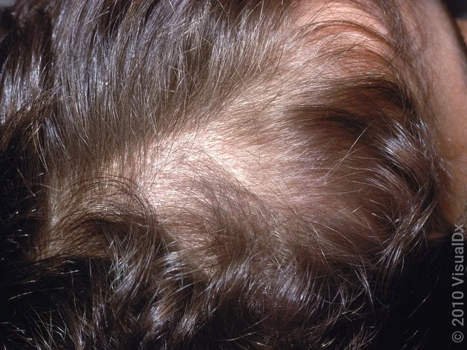 Close-up of thick scales in scalp psoriasis.