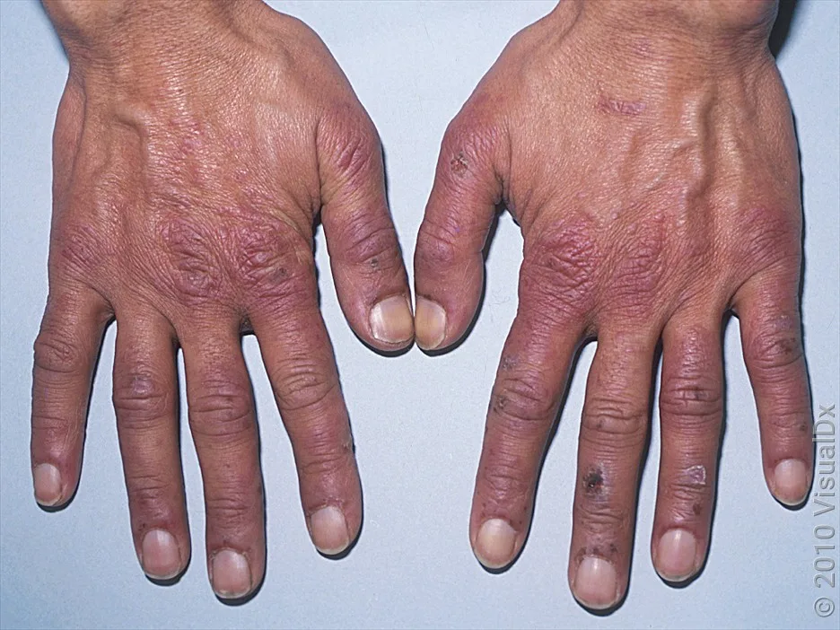 Chilblains over the interphalangeal joints and the metacapralphalangeal joints.