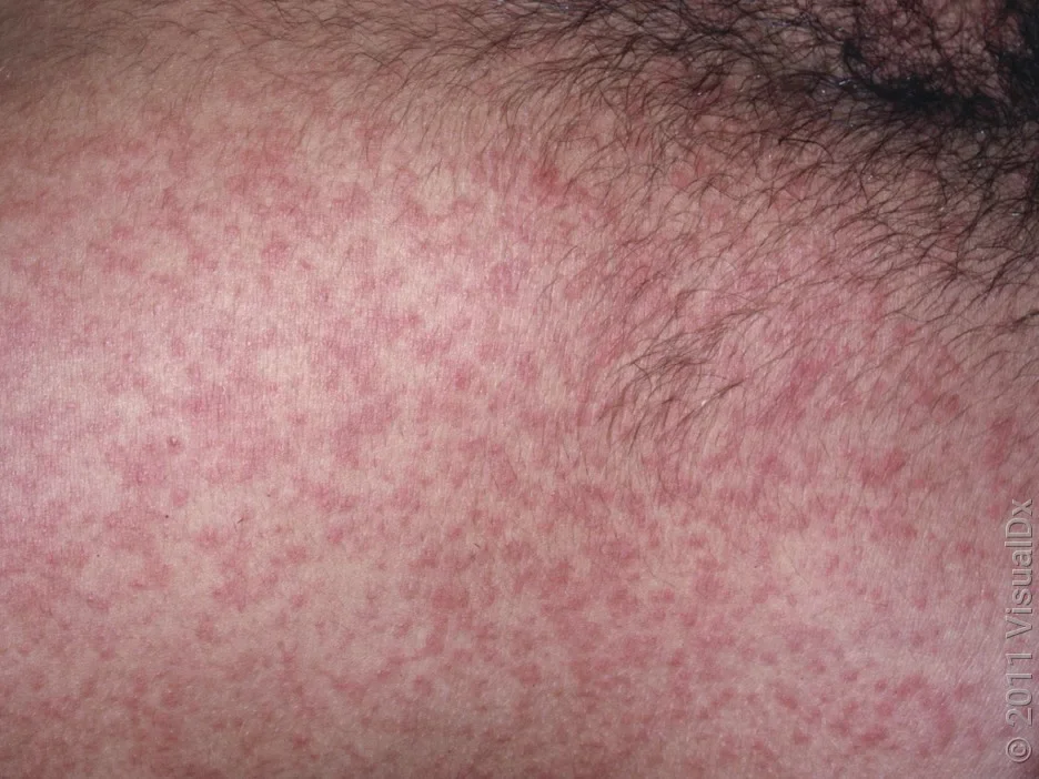 Close-up of the mono rash on the torso.