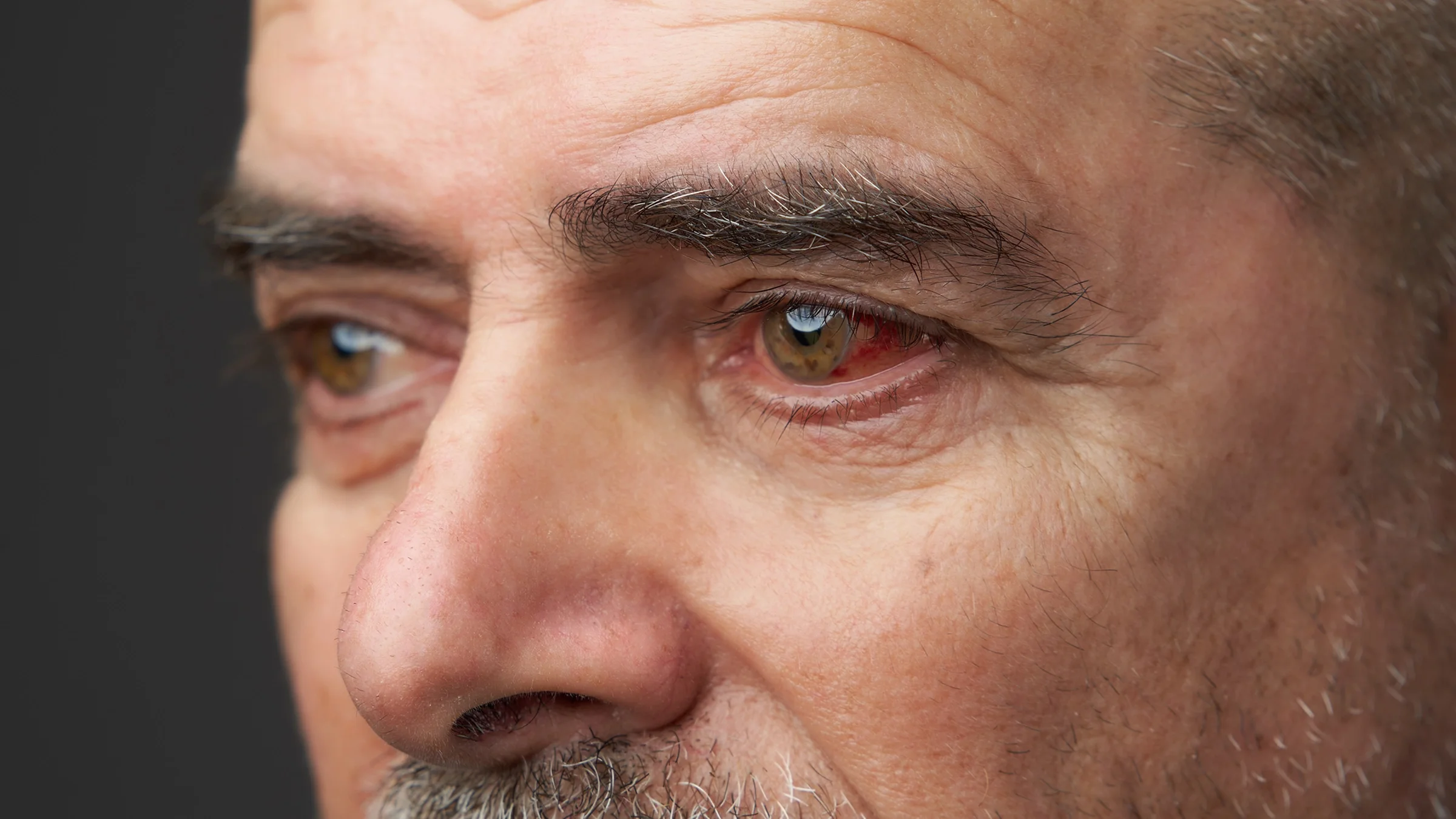 A man with slightly red eyes looks away from the camera.