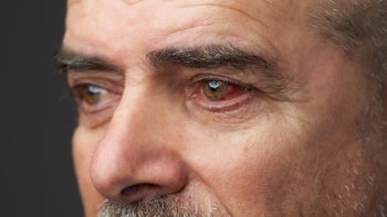 Eye inflammation: close up man conjunctivitis 1215109945