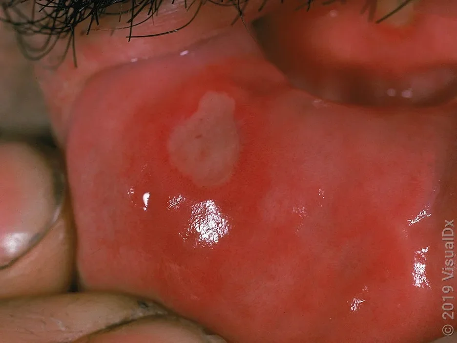 Close-up of a canker sore on the lower lip.