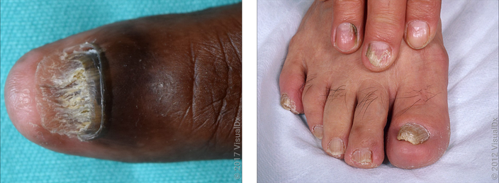 Left: Close-up of a fingernail that is thick, broken off and short. Right: Several fingernails and toenails are thick and discolored. 