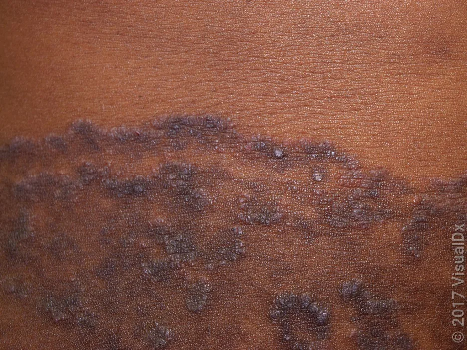 Close-up of a rash in jock itch. 
