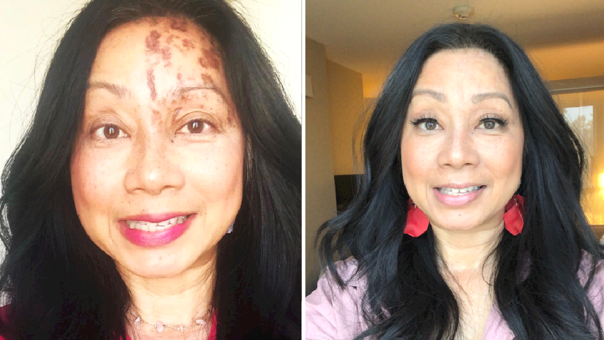 Laarni San Juan before and after