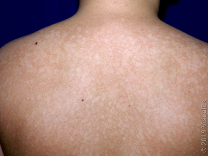 Close-up of the back with tinea versicolor. 