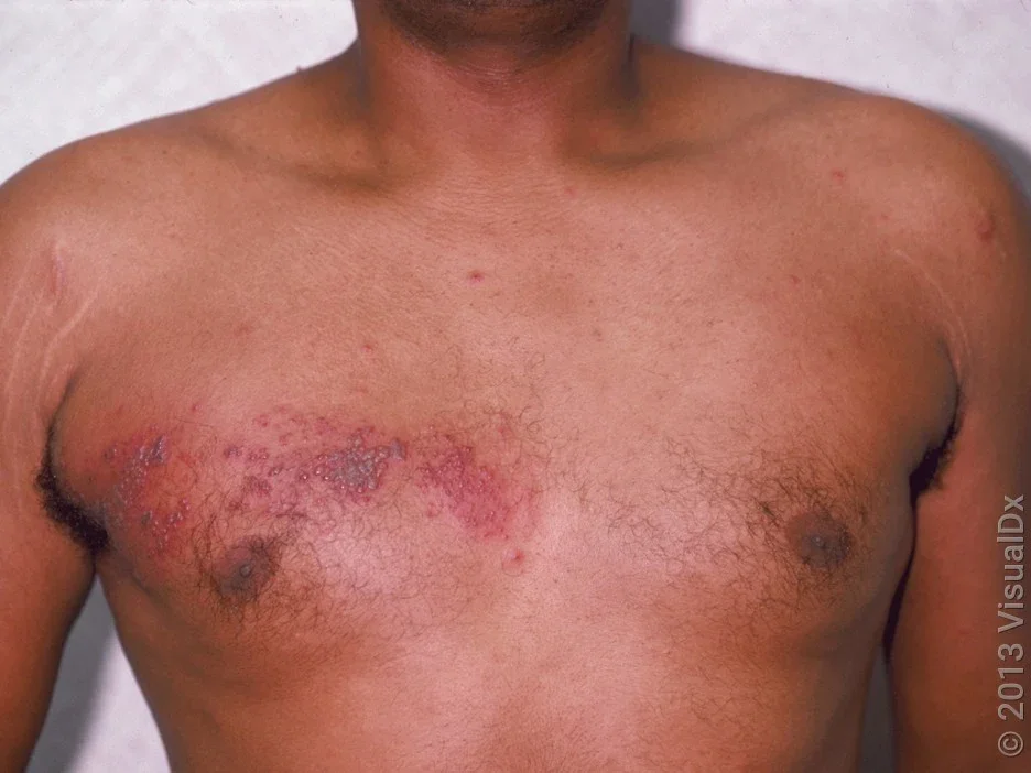 A shingles outbreak on the chest of a person with darker skin.  
