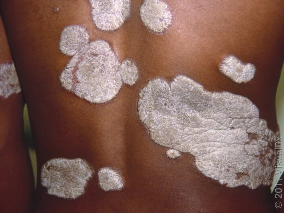 Close-up of back with large dark brown patches of psoriasis covered in thick white scale.  