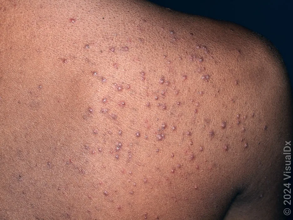 Close-up of fungal acne on the back and shoulder.
