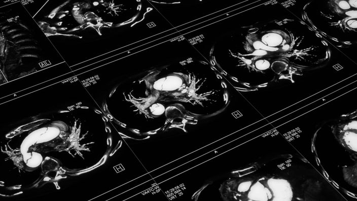 Close-up of brain scans up on a light box.