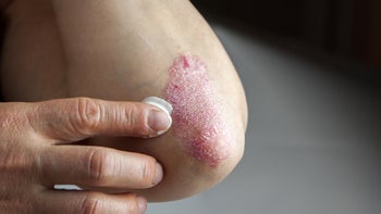 Psoriasis: Dermatology: closeup psoriasis on elbow 497413495