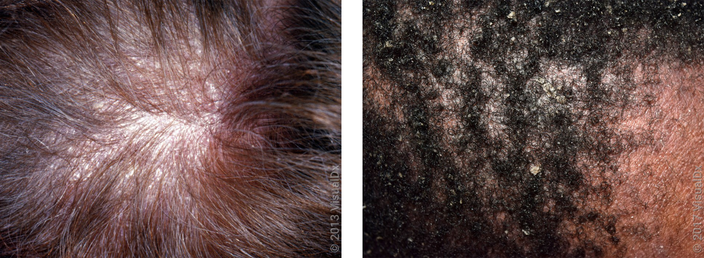 Itchy online scalp flakes